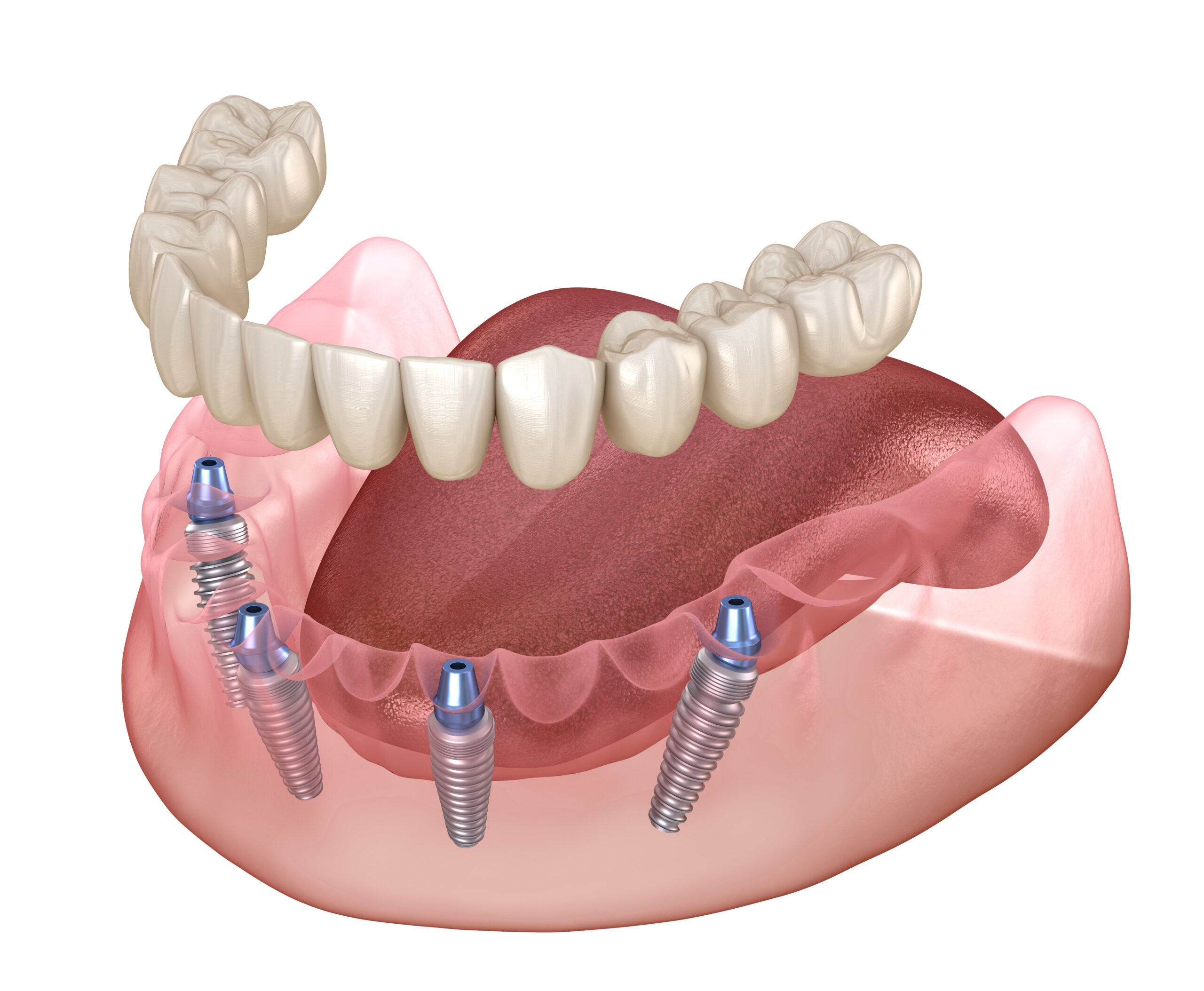 При имплантации по методу «ВСЕ-НА-4» и «ВСЕ-НА-6» удаление зубов включено в стоимость
